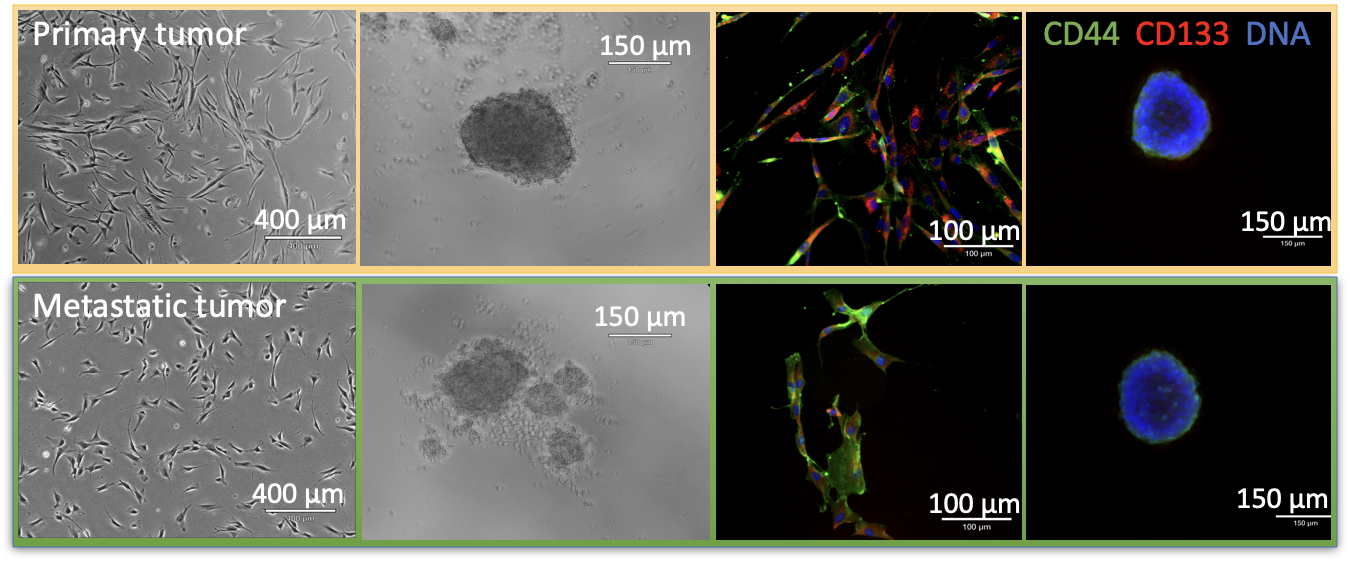 Primary and metastatic tumors exhibit distinctly different behavior. Top row: light microscopy images of cultivated patient-derived primary cancer stem-like cells (CRCs) and spheroids grown from these cells. Bottom row: images of metastatic CRCs. Both cell populations exhibit distinct morphologies, and express common CSC markers CD44 and CD133. Figure courtesy Laureen Helweg, Bielefeld University